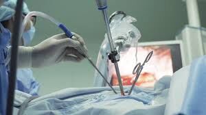 Successful Thoracolaparoscopic Esophagectomy for Esophageal Cancer | Dr. Pavan Kumar C G