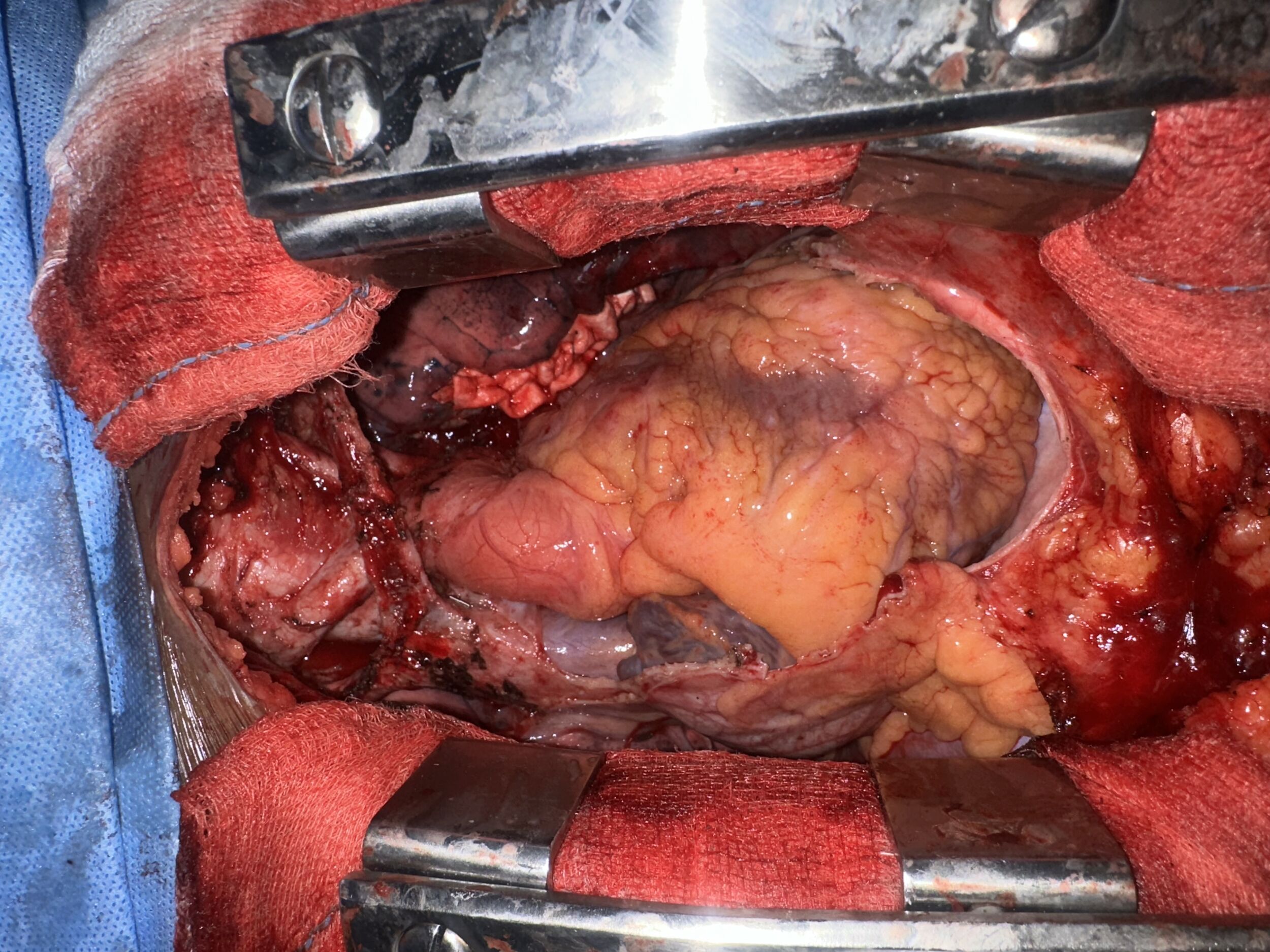 Surgical Management of Mediastinal Germ Cell Tumor