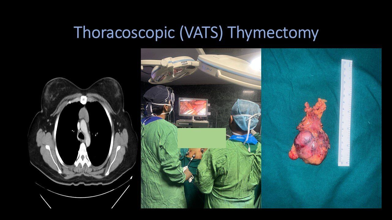 Thoracoscopic (VATS) Thymectomy for Thymoma