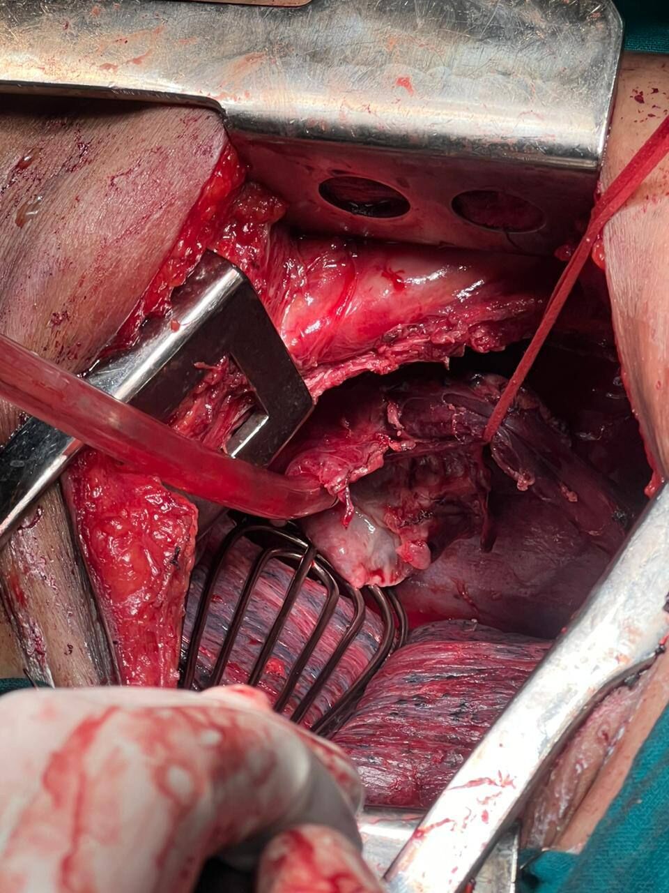 emergency-transthoracic--esophagectomy-for-perforated-esophageal-cancer--dr-pavan-kumar-thumbnail