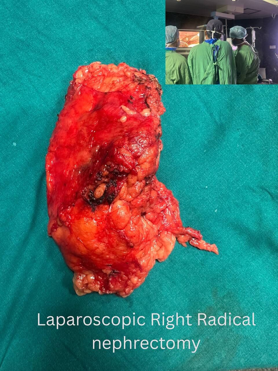 Laparoscopic Right Radical Nephrectomy for Renal Cell Carcinoma