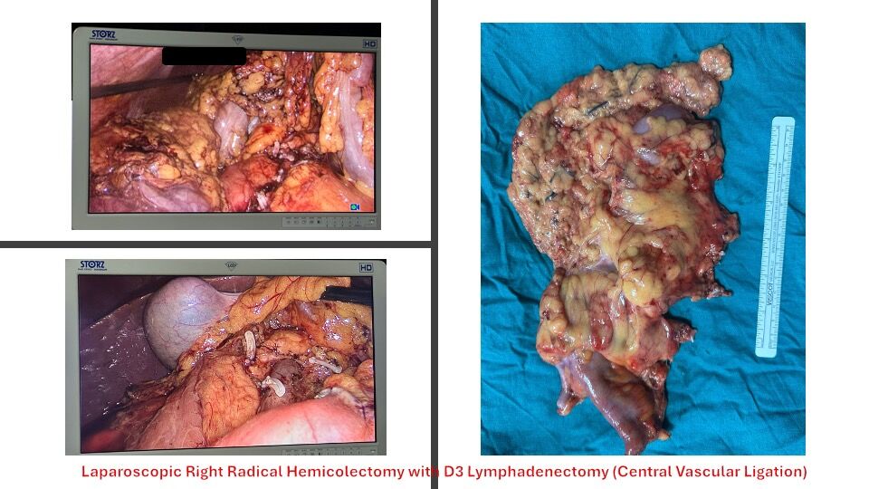 laparoscopic-right-radical-hemicolectomy-with-d3-lymphadenectomy-central-vascular-ligation-image