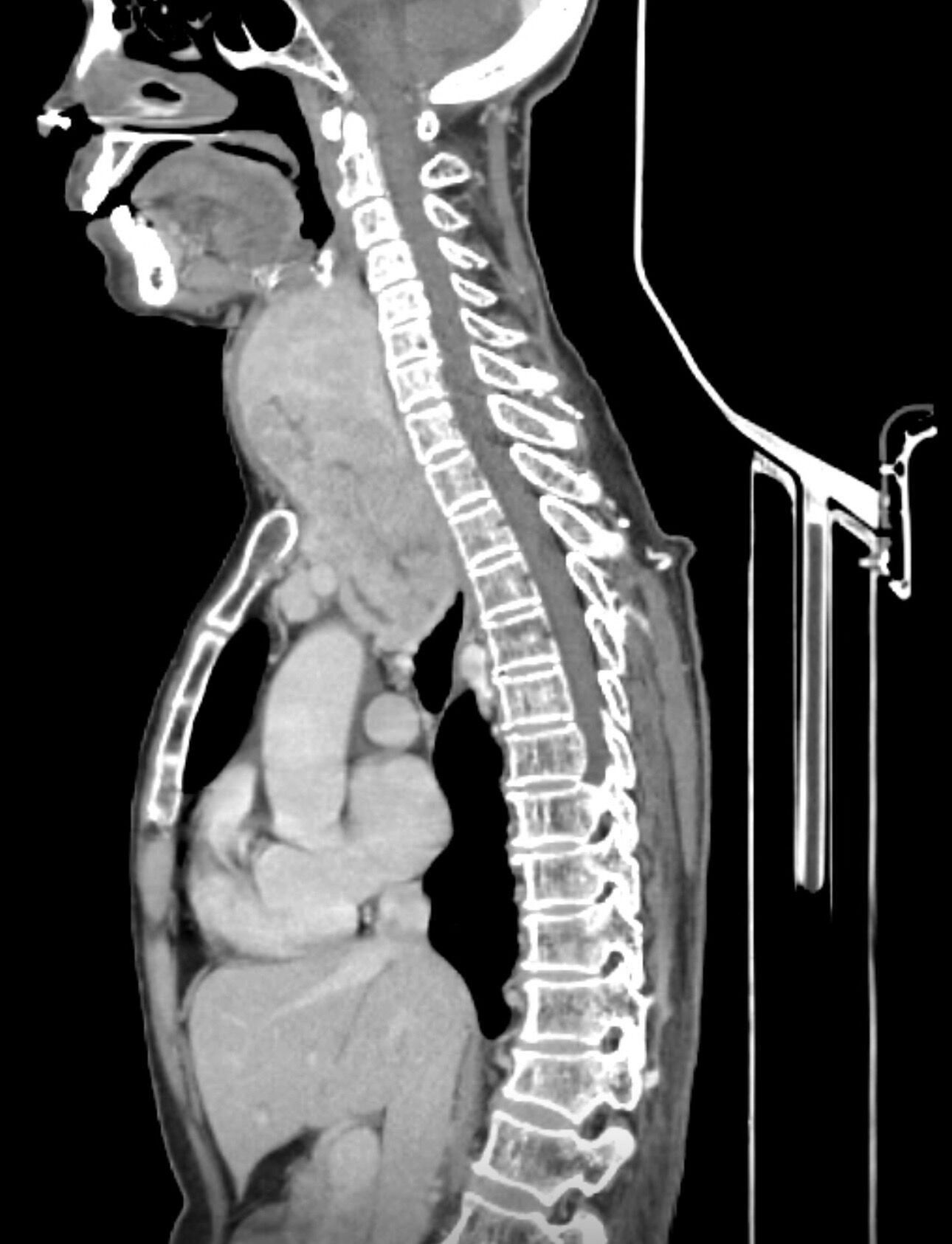 most-retrosternal-goitres-can-be-removed-through-the-neck-a-challenging-case-of-giant-retrosternal-goitre-thumbnail