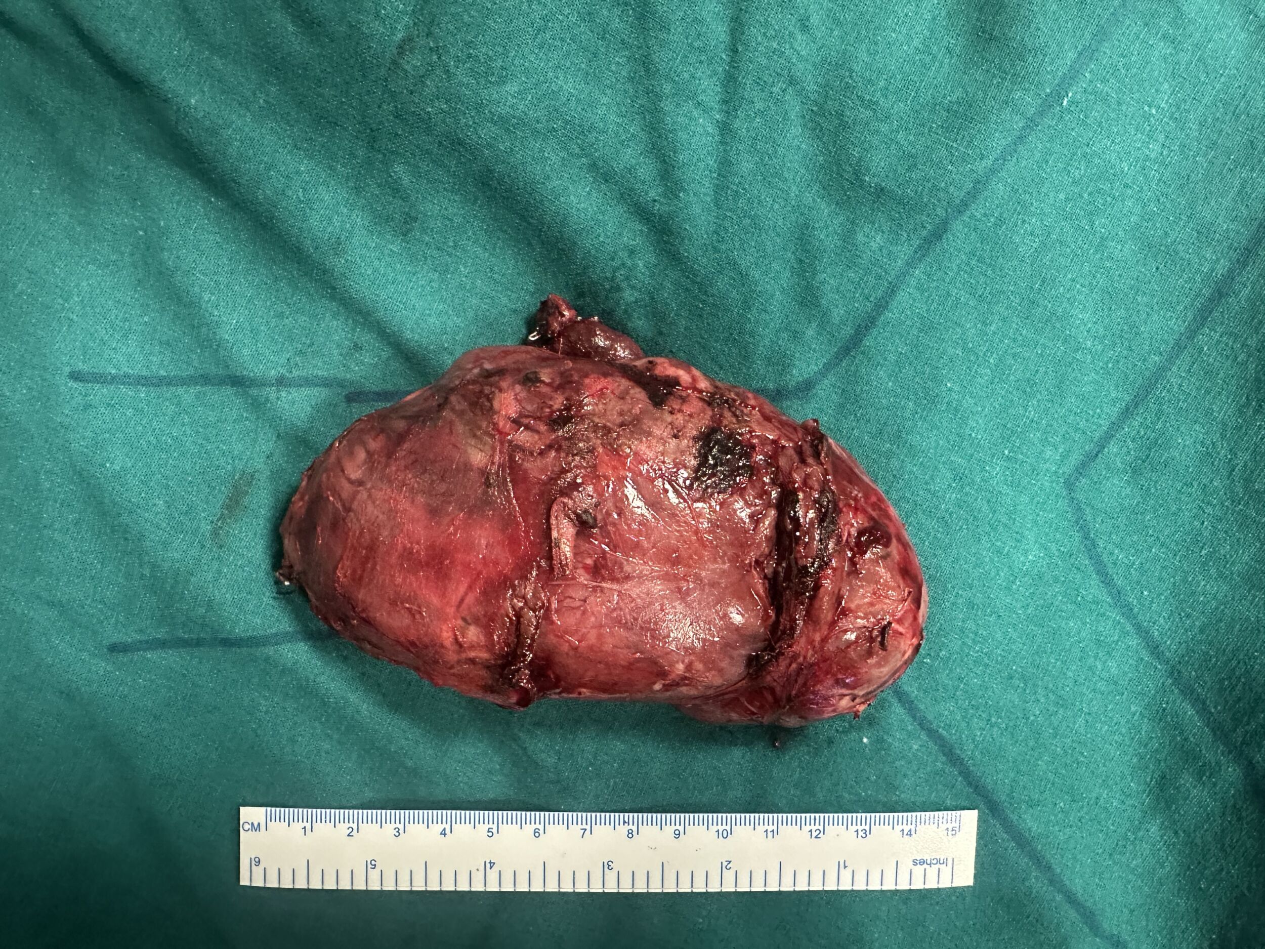 most-retrosternal-goitres-can-be-removed-through-the-neck-a-challenging-case-of-giant-retrosternal-goitre-image